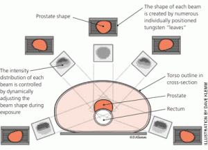 Radiation Therapy